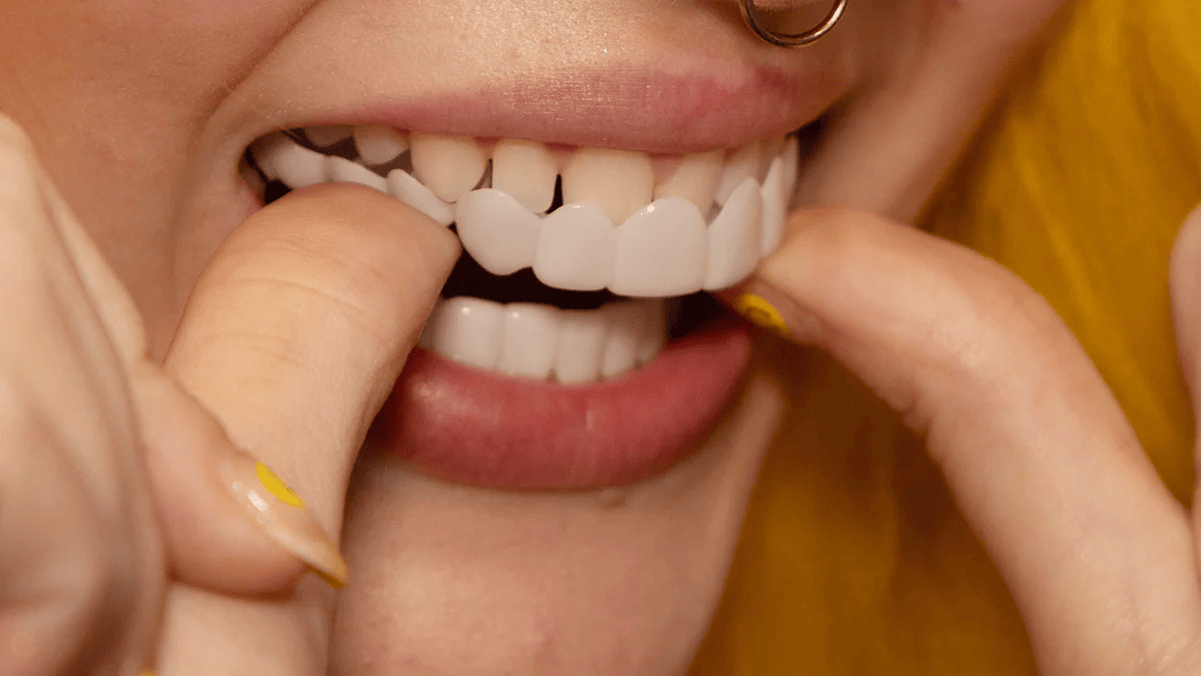 Instant smile transformation with Snap on Smile veneers 6