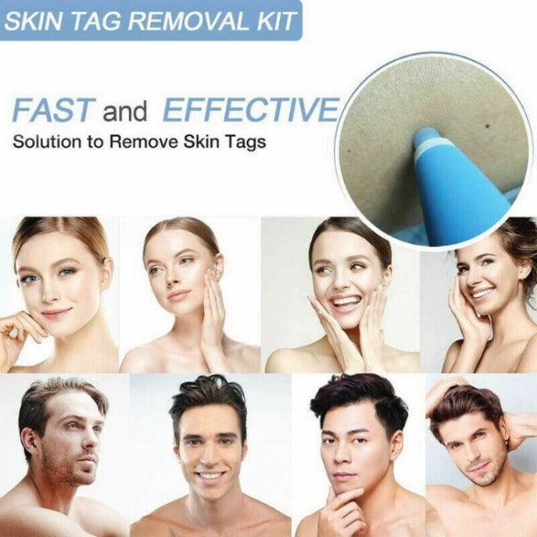 Skin Tag Removal Kit - Natural Painless Auto SKIN TAG Removal Skin tag bands Remover Device 2