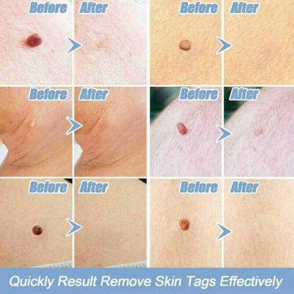 Skin Tag Removal Kit - Natural Painless Auto SKIN TAG Removal Skin tag bands Remover Device 3