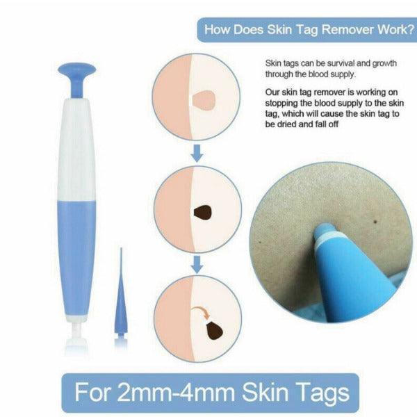 Skin Tag Removal Kit - Natural Painless Auto SKIN TAG Removal Skin tag bands Remover Device 4