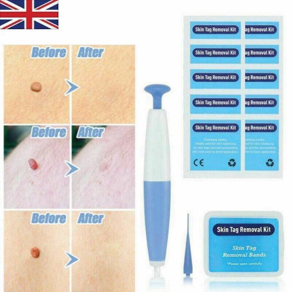 Skin Tag Removal Kit - Natural Painless Auto SKIN TAG Removal Skin tag bands Remover Device 7